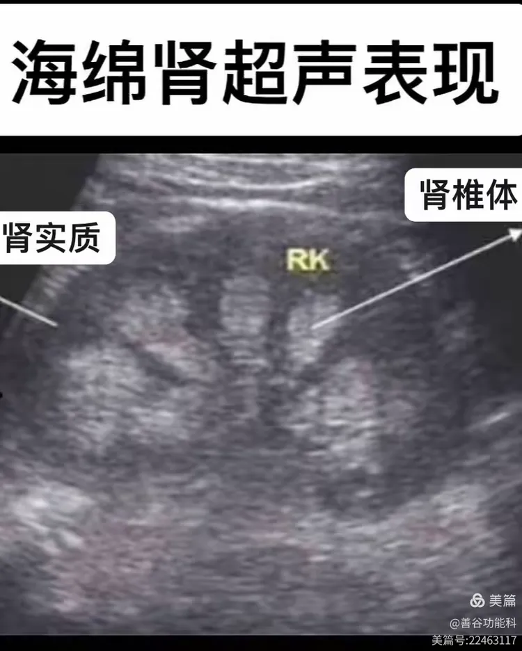 髓质海绵肾您了解多少?